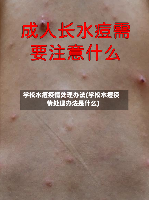 学校水痘疫情处理办法(学校水痘疫情处理办法是什么)-第2张图片